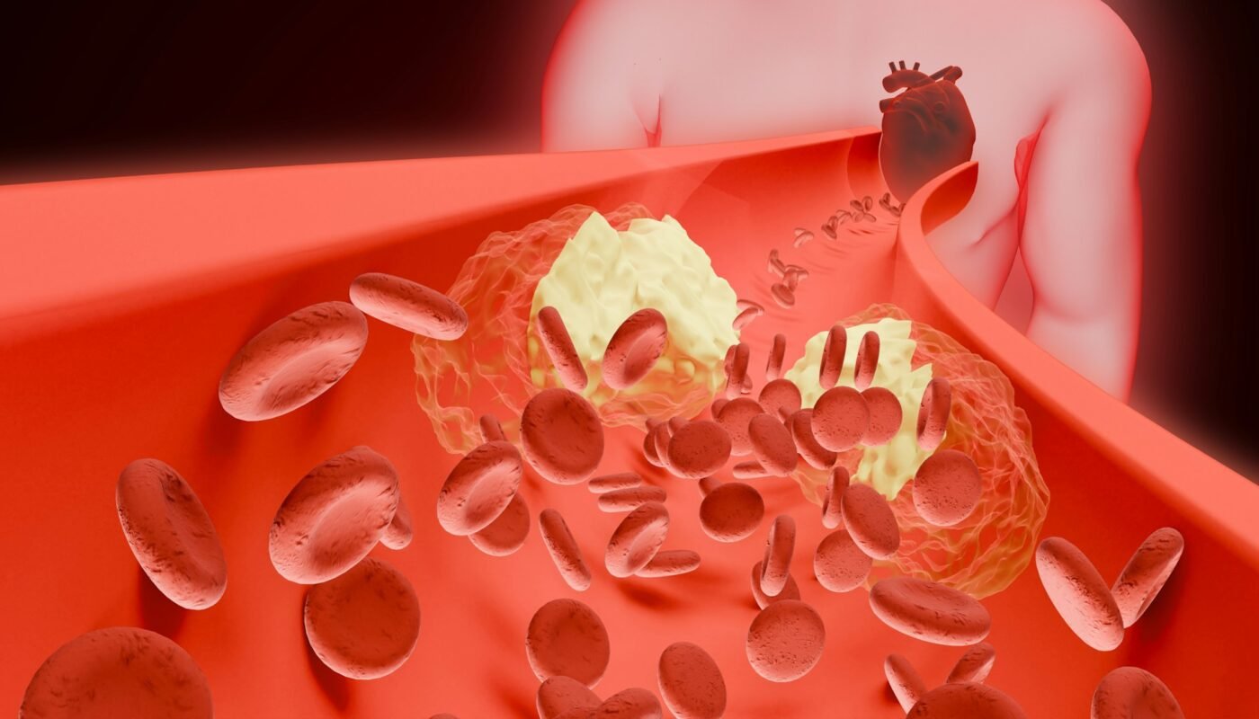 Deep Vein Thrombosis