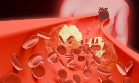 Deep Vein Thrombosis