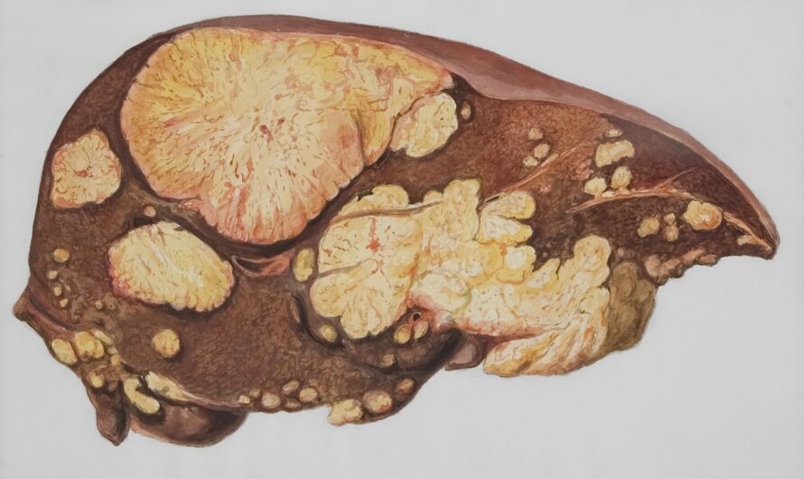 Men’s Liver Health – Experimental Mash Treatment Drug Shows Promise At University Of Michigan